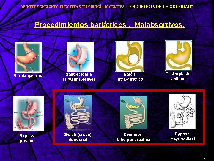 REINTERVENCIONES ELECTIVAS EN CIRUGÍA DIGESTIVA. - ”EN CIRUGIA DE LA OBESIDAD” Procedimientos bariátricos. Malabsortivos.