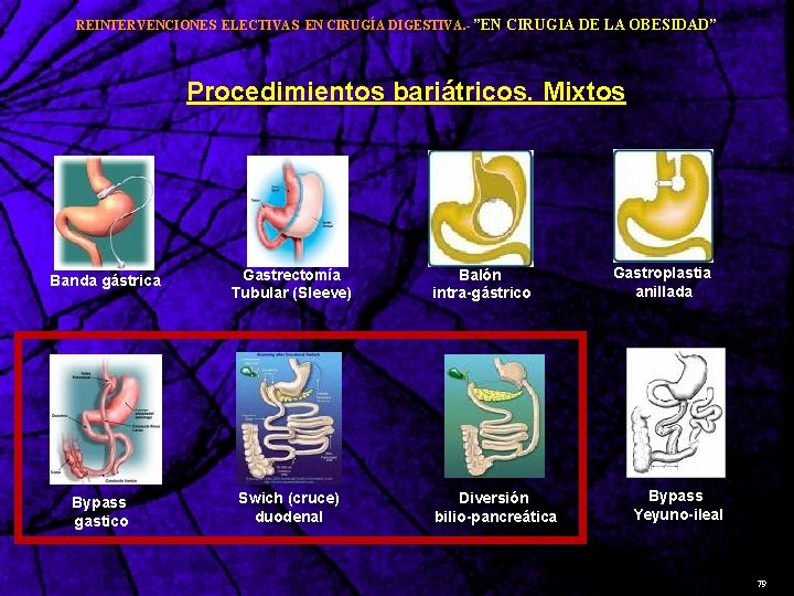 REINTERVENCIONES ELECTIVAS EN CIRUGÍA DIGESTIVA. - ”EN CIRUGIA DE LA OBESIDAD” Procedimientos bariátricos. Mixtos