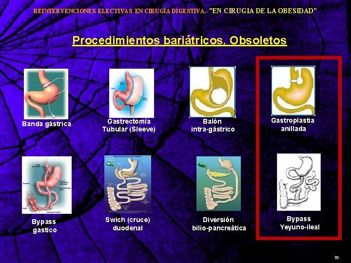 REINTERVENCIONES ELECTIVAS EN CIRUGÍA DIGESTIVA. - ”EN CIRUGIA DE LA OBESIDAD” Procedimientos bariátricos. Obsoletos