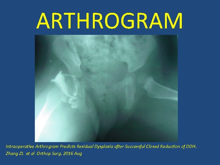 ARTHROGRAM Intraoperative Arthrogram Predicts Residual Dysplasia after Successful Closed Reduction of DDH. Zhang ZL