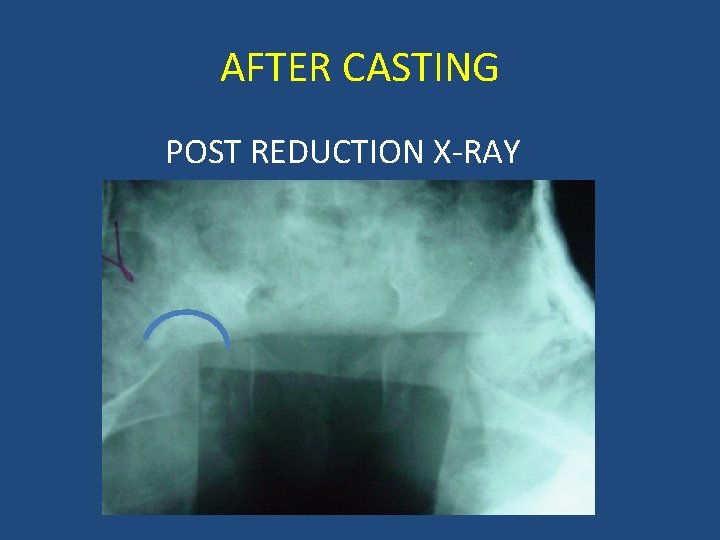 AFTER CASTING POST REDUCTION X-RAY 
