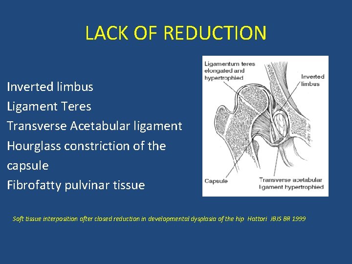 LACK OF REDUCTION Inverted limbus Ligament Teres Transverse Acetabular ligament Hourglass constriction of the