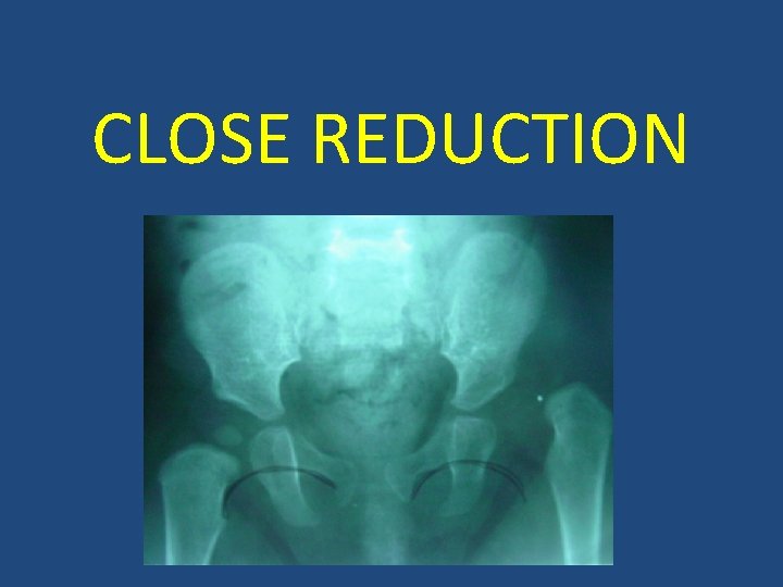 CLOSE REDUCTION 
