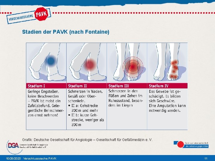 Stadien der PAVK (nach Fontaine) Grafik: Deutsche Gesellschaft für Angiologie – Gesellschaft für Gefäßmedizin