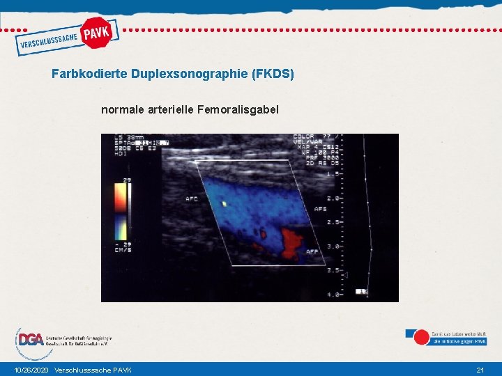 Farbkodierte Duplexsonographie (FKDS) normale arterielle Femoralisgabel 10/26/2020 Verschlusssache PAVK 21 