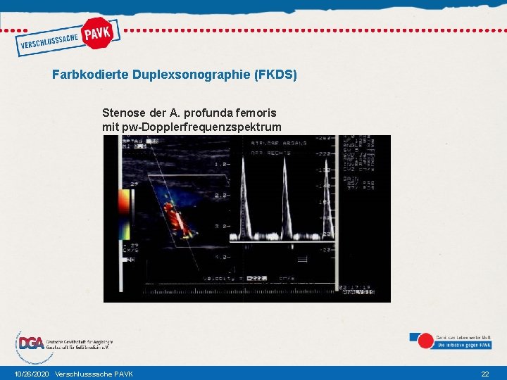 Farbkodierte Duplexsonographie (FKDS) Stenose der A. profunda femoris mit pw-Dopplerfrequenzspektrum 10/26/2020 Verschlusssache PAVK 22