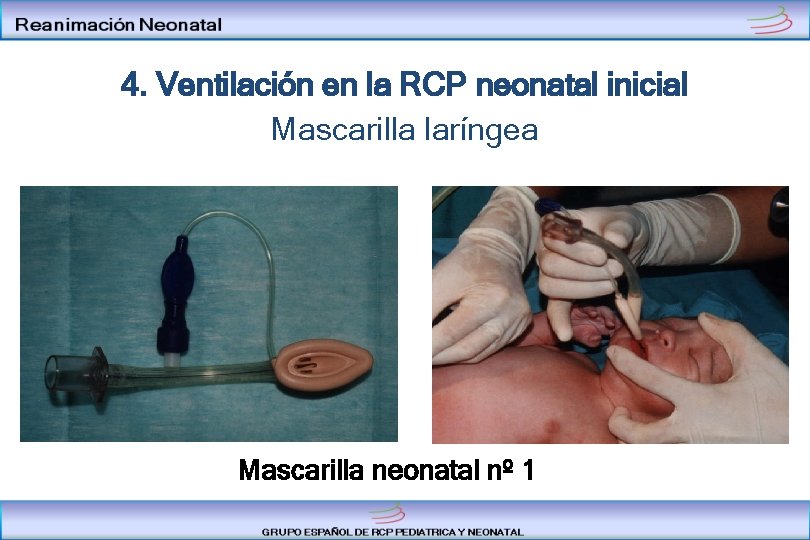 4. Ventilación en la RCP neonatal inicial Mascarilla laríngea Mascarilla neonatal nº 1 