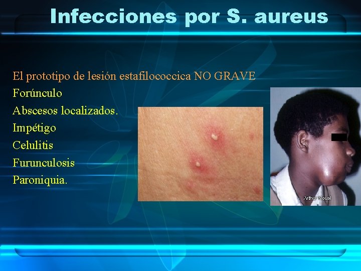 Infecciones por S. aureus El prototipo de lesión estafilococcica NO GRAVE Forúnculo Abscesos localizados.