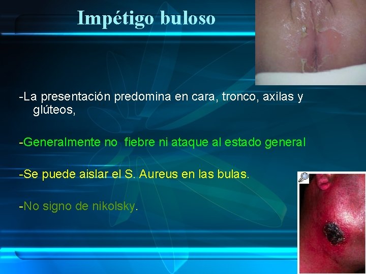 Impétigo buloso -La presentación predomina en cara, tronco, axilas y glúteos, -Generalmente no fiebre