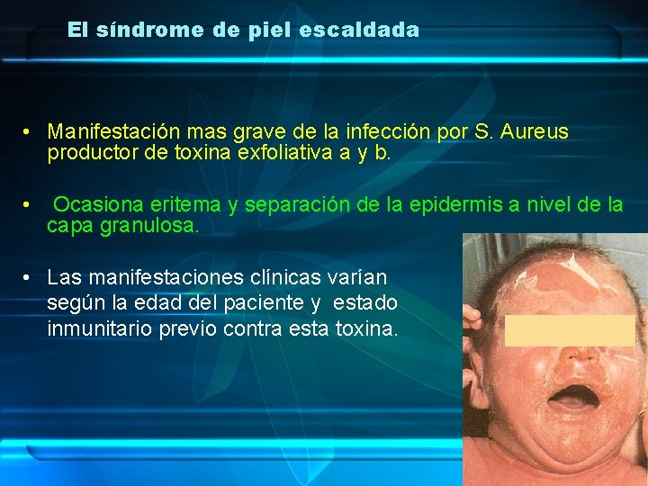 El síndrome de piel escaldada • Manifestación mas grave de la infección por S.