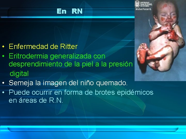 En RN • Enfermedad de Ritter • Eritrodermia generalizada con desprendimiento de la piel