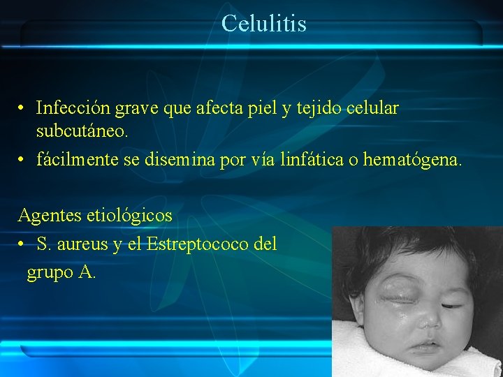 Celulitis • Infección grave que afecta piel y tejido celular subcutáneo. • fácilmente se