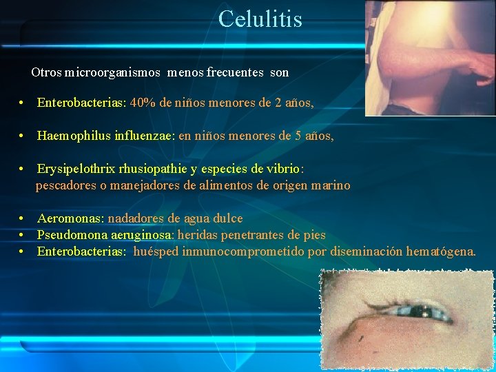 Celulitis Otros microorganismos menos frecuentes son • Enterobacterias: 40% de niños menores de 2