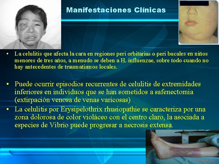 Manifestaciones Clínicas • La celulitis que afecta la cara en regiones peri orbitarias o