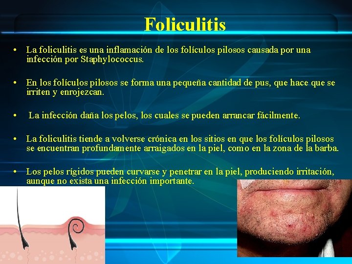 Foliculitis • La foliculitis es una inflamación de los folículos pilosos causada por una