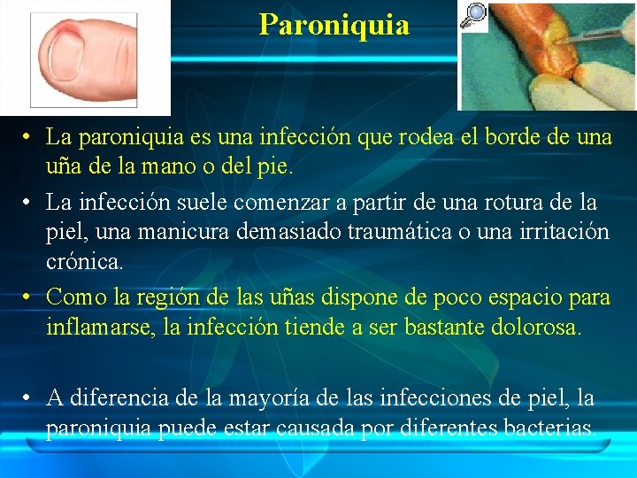 Paroniquia • La paroniquia es una infección que rodea el borde de una uña