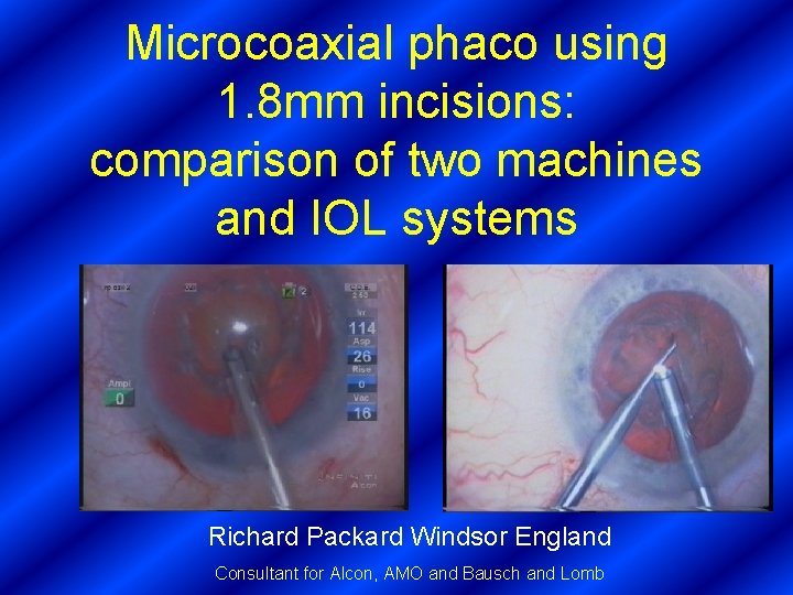 Microcoaxial phaco using 1. 8 mm incisions: comparison of two machines and IOL systems