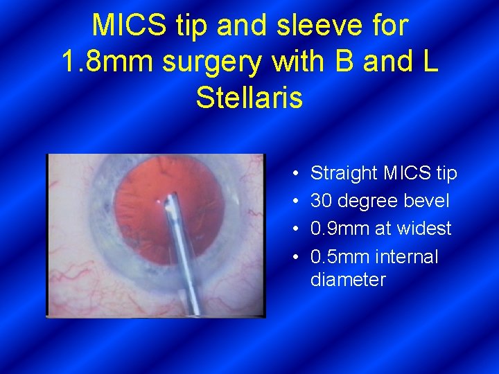 MICS tip and sleeve for 1. 8 mm surgery with B and L Stellaris