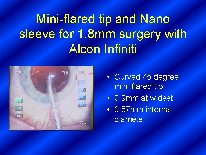 Mini-flared tip and Nano sleeve for 1. 8 mm surgery with Alcon Infiniti •