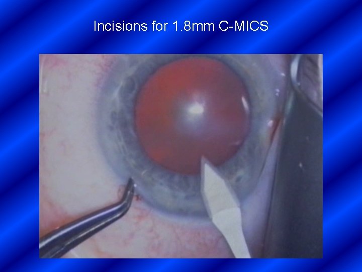 Incisions for 1. 8 mm C-MICS 