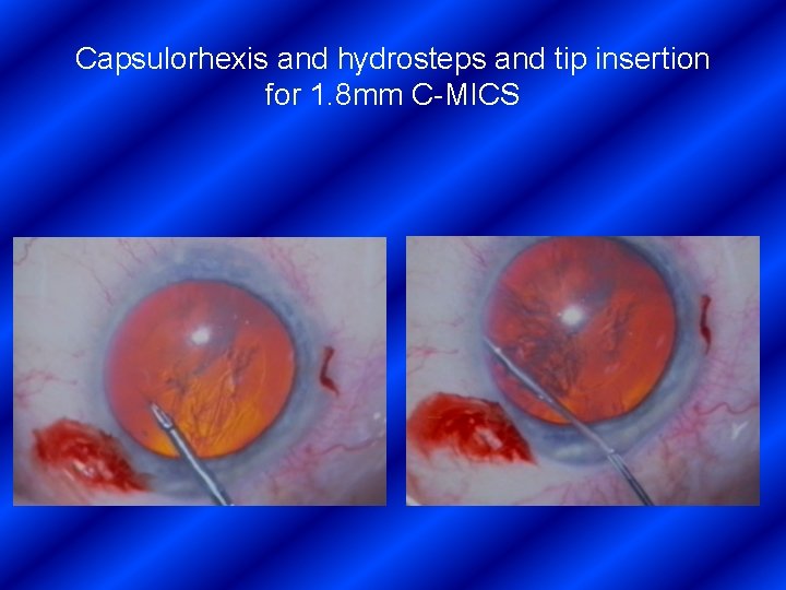 Capsulorhexis and hydrosteps and tip insertion for 1. 8 mm C-MICS 