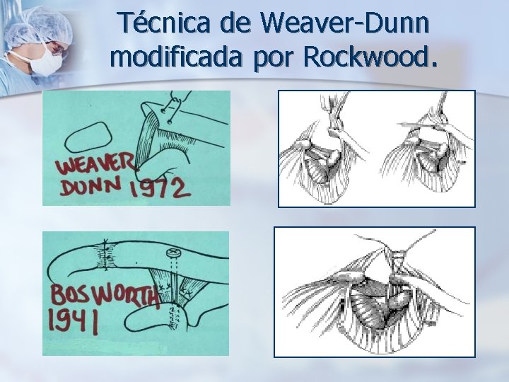 Técnica de Weaver-Dunn modificada por Rockwood. 