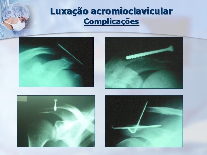 Luxação acromioclavicular Complicações 