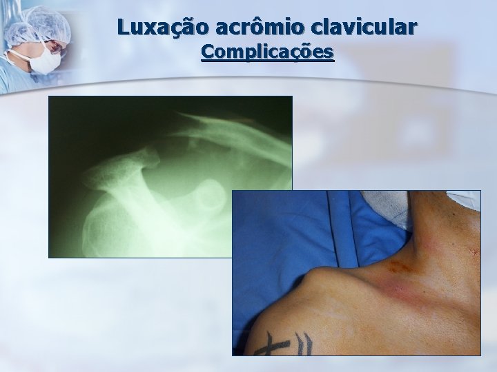 Luxação acrômio clavicular Complicações 