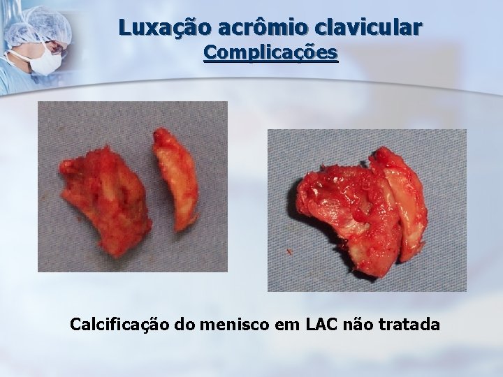 Luxação acrômio clavicular Complicações Calcificação do menisco em LAC não tratada 