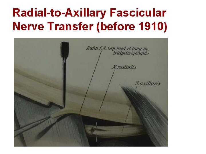 Radial-to-Axillary Fascicular Nerve Transfer (before 1910) 