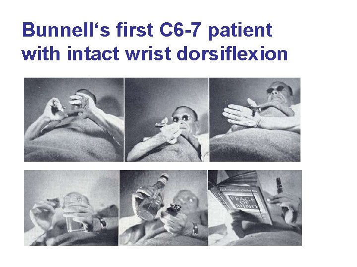 Bunnell‘s first C 6 -7 patient with intact wrist dorsiflexion 