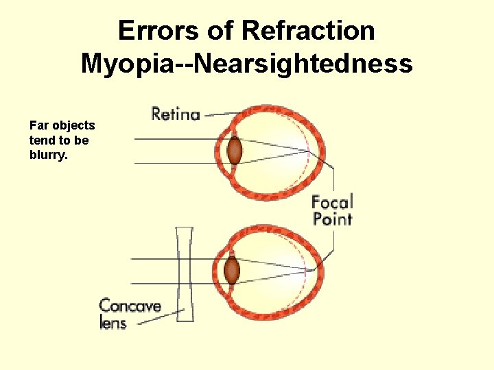 Errors of Refraction Myopia--Nearsightedness Far objects tend to be blurry. 