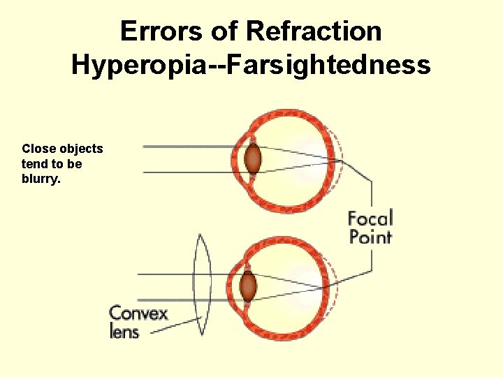 Errors of Refraction Hyperopia--Farsightedness Close objects tend to be blurry. 