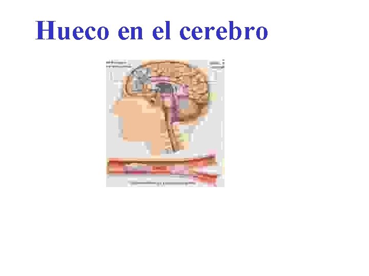 Hueco en el cerebro 
