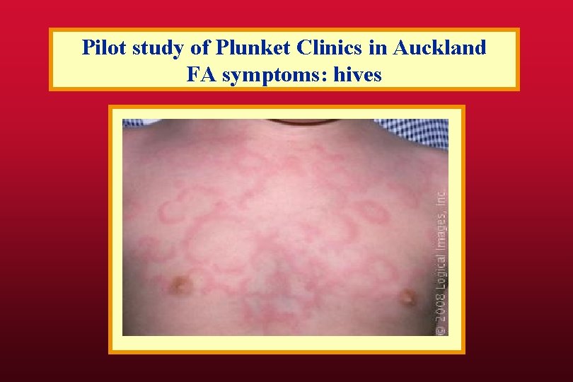 Pilot study of Plunket Clinics in Auckland FA symptoms: hives 