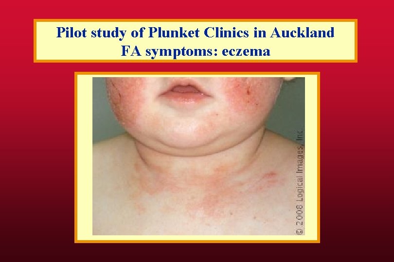 Pilot study of Plunket Clinics in Auckland FA symptoms: eczema 