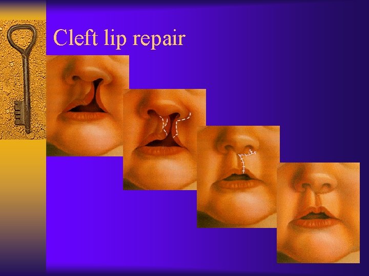 Cleft lip repair 