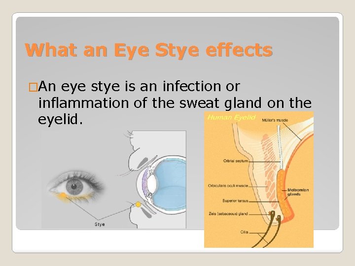 What an Eye Stye effects �An eye stye is an infection or inflammation of