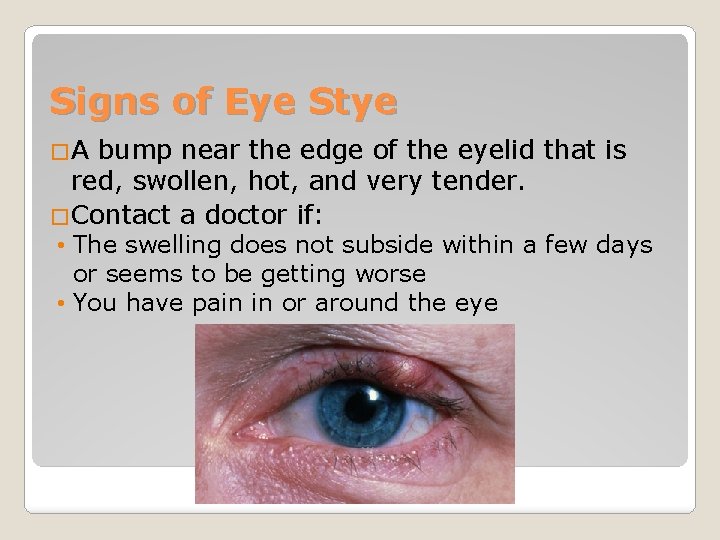 Signs of Eye Stye �A bump near the edge of the eyelid that is