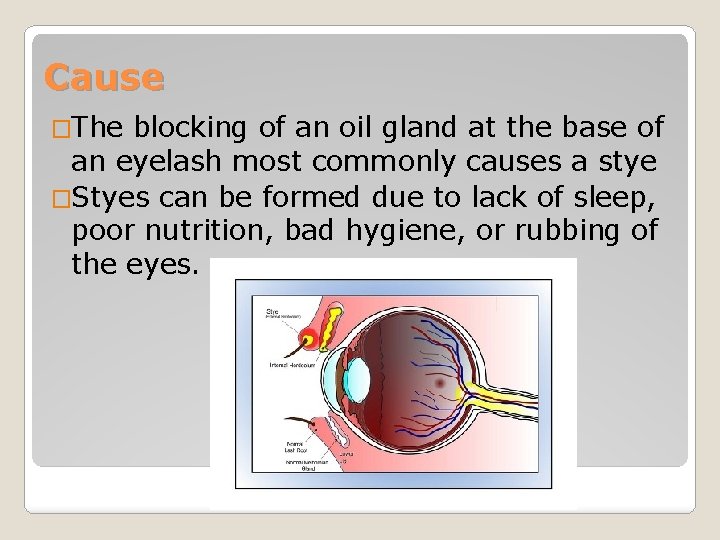 Cause �The blocking of an oil gland at the base of an eyelash most