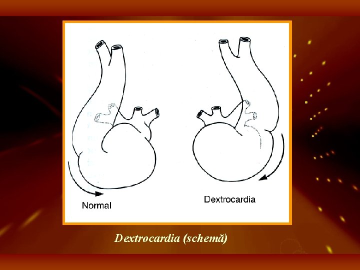 Dextrocardia (schemă) 
