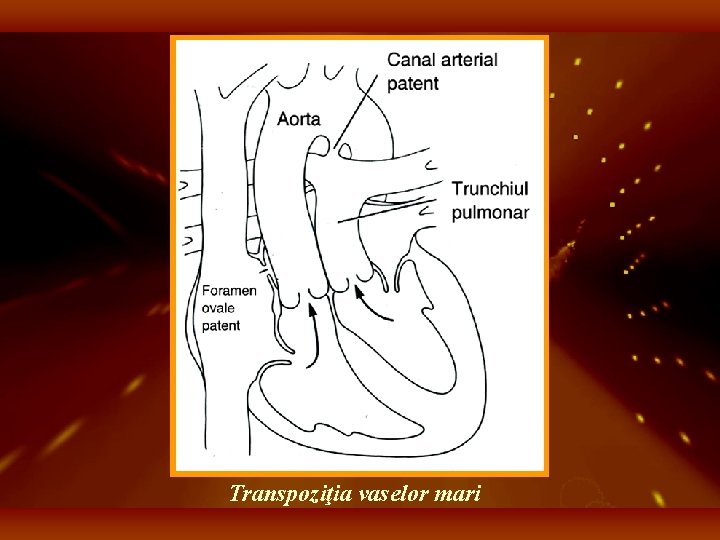 Transpoziţia vaselor mari 