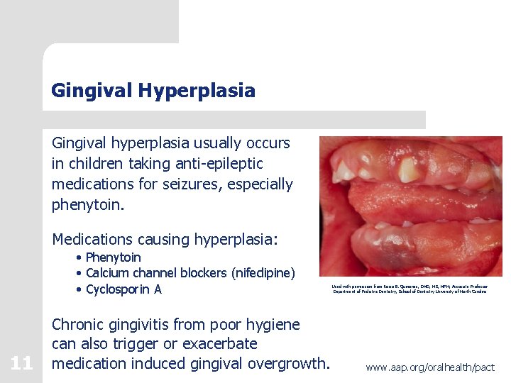 Gingival Hyperplasia Gingival hyperplasia usually occurs in children taking anti-epileptic medications for seizures, especially