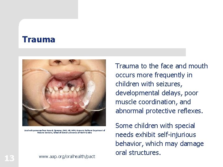 Trauma to the face and mouth occurs more frequently in children with seizures, developmental