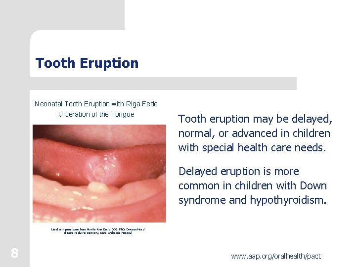 Tooth Eruption Neonatal Tooth Eruption with Riga Fede Ulceration of the Tongue Tooth eruption