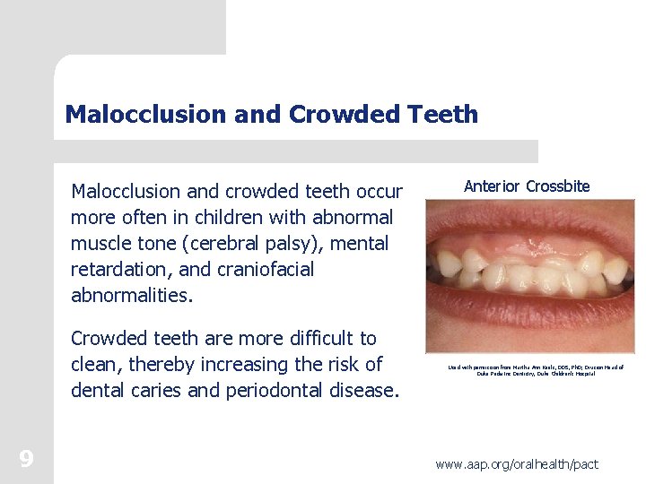 Malocclusion and Crowded Teeth Malocclusion and crowded teeth occur more often in children with