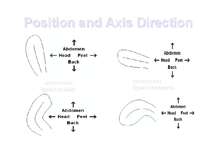Position and Axis Direction anteversion: tipped forward anteflexion: the fundus is pointing forwards. The
