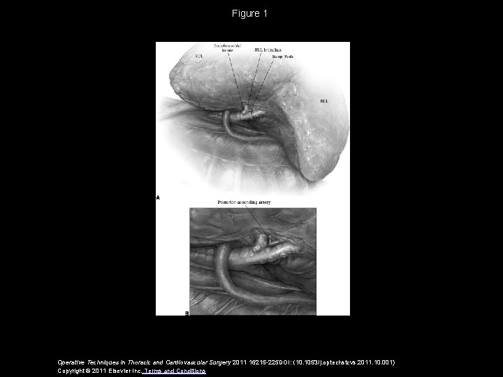 Figure 1 Operative Techniques in Thoracic and Cardiovascular Surgery 2011 16215 -225 DOI: (10.