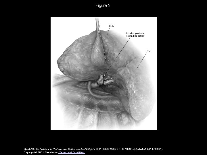 Figure 2 Operative Techniques in Thoracic and Cardiovascular Surgery 2011 16215 -225 DOI: (10.