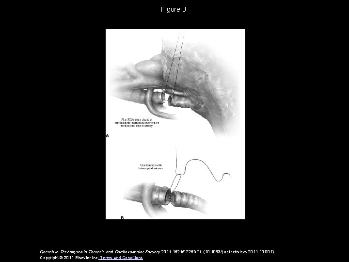 Figure 3 Operative Techniques in Thoracic and Cardiovascular Surgery 2011 16215 -225 DOI: (10.